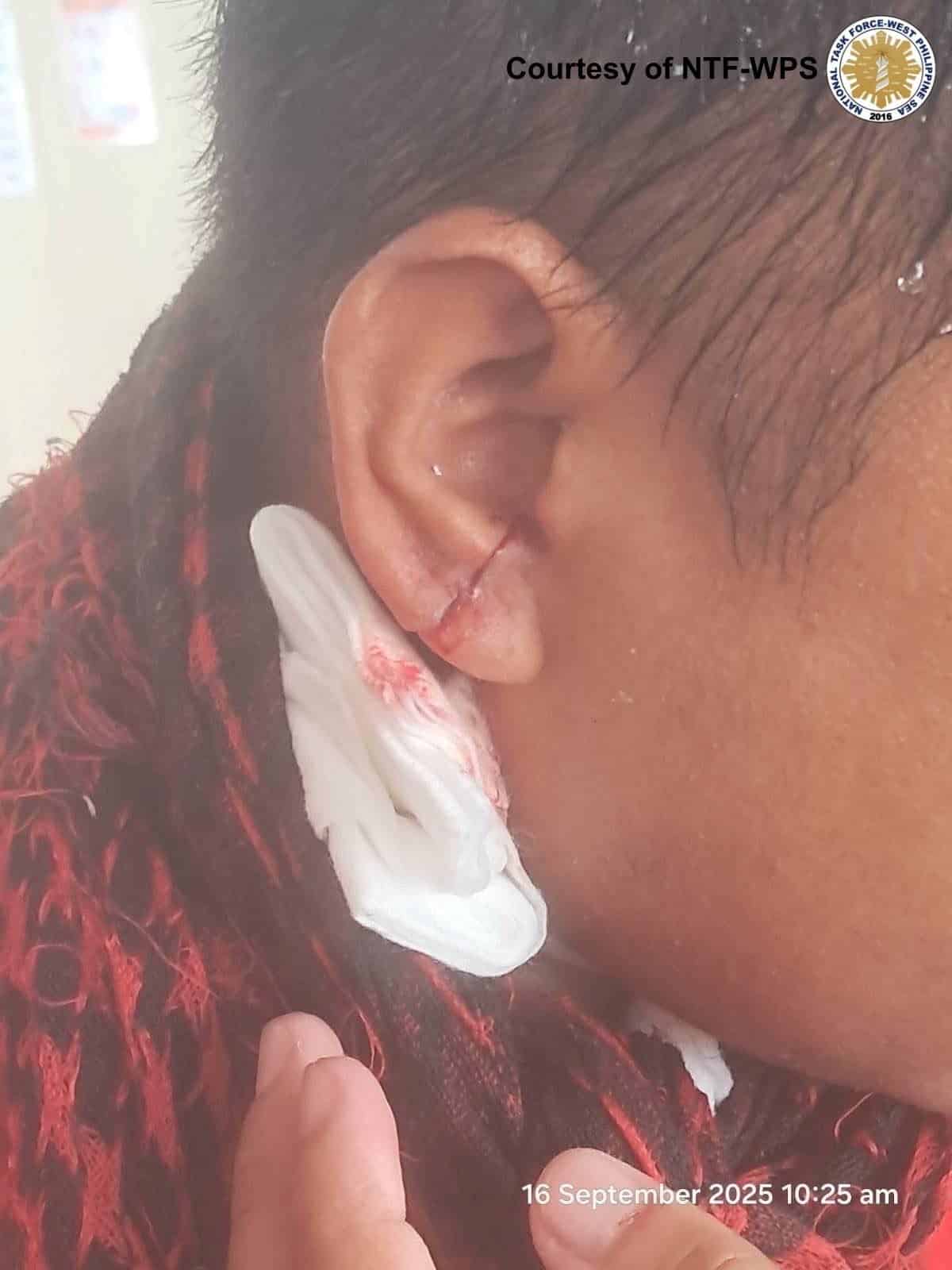 Photo shows the injured ear of a Bureau of Fisheries and Aquatic Resources crew member after a flying glass hit him when a China Coast Guard ship blasted their vessel with a water cannon near Bajo de Masinloc.