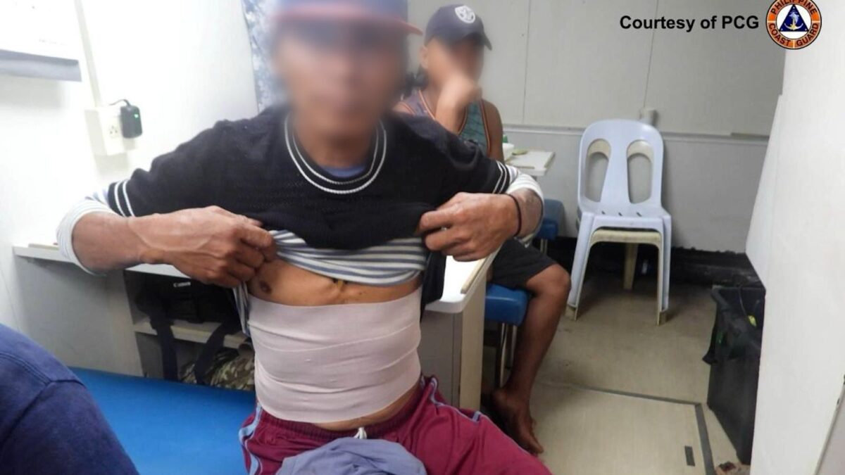 Photo shows the injuries sustained by three fishers after being harassed by Chinese vessels near Escoda Shoal on Friday. (Photo courtesy of PCG)